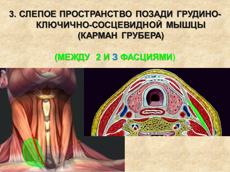 3. СЛЕПОЕ ПРОСТРАНСТВО ПОЗАДИ ГРУДИНО-КЛЮЧИЧНО-СОСЦЕВИДНОЙ МЫШЦЫ (КАРМАН ГРУБЕРА)  (МЕЖДУ  2 И З